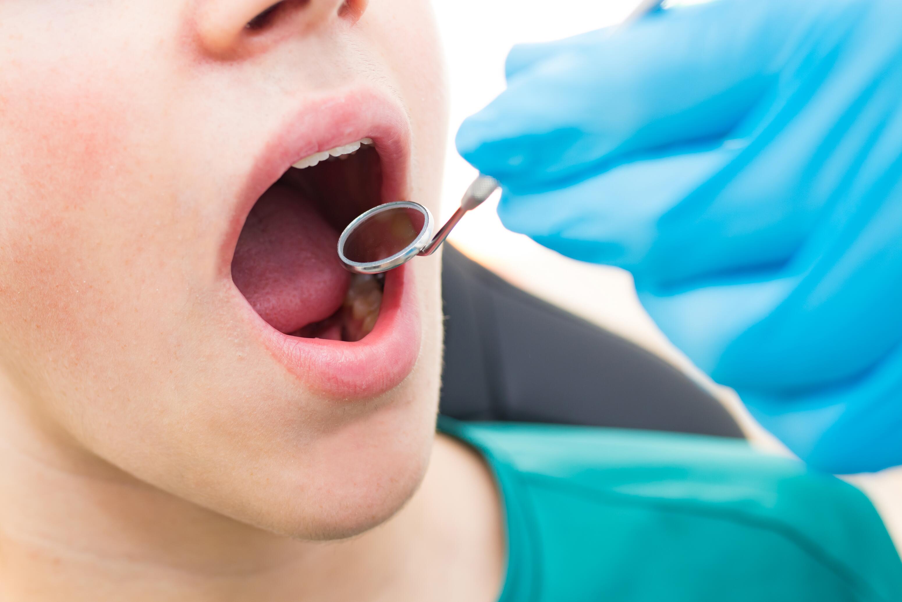 risques d’une carie non traitée sur la denture définitive chez l’adulte